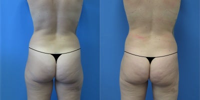 Liposuction before and after photo
