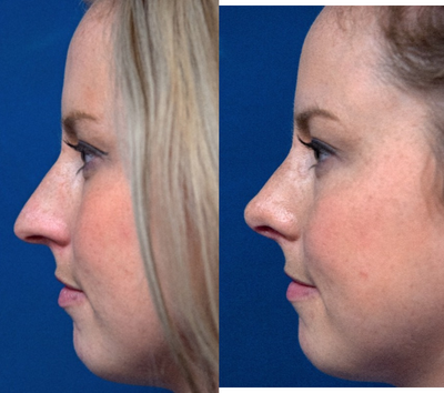 Rhinoplasty before and after photo