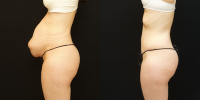 Tummy Tuck before and after photo