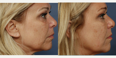 Botox before and after photo