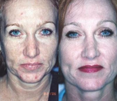Fractional Laser before and after photo