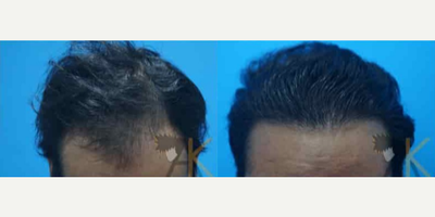 Hair Transplant before and after photo