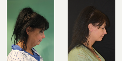 Neck Lift before and after photo