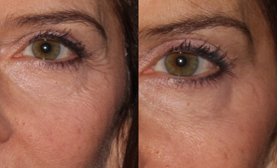 Botox before and after photo