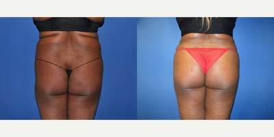 Brazilian Butt Lift before and after photo
