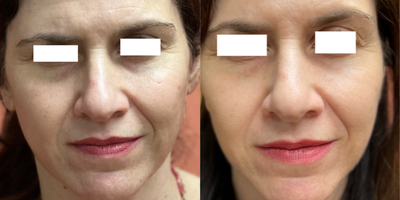 Clear and Brilliant before and after photo