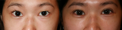Double Eyelid Surgery before and after photo