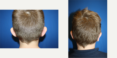 Ear Surgery before and after photo