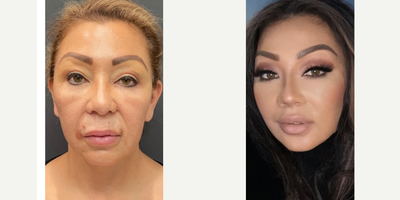 Lip Lift before and after photo