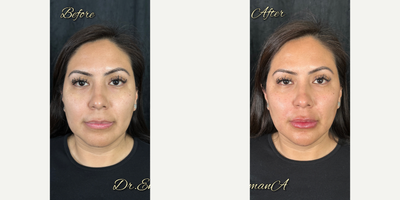 Liquid Facelift before and after photo