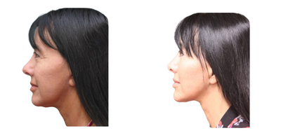 Mini Facelift before and after photo