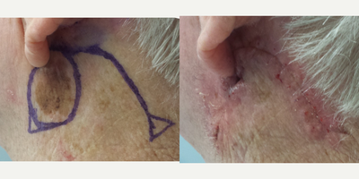 Facial Reconstructive Surgery before and after photo