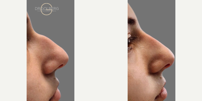 Nonsurgical Nose Job before and after photo