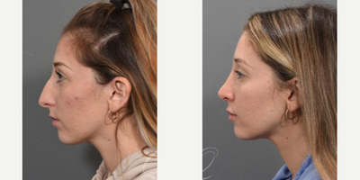 Rhinoplasty before and after photo
