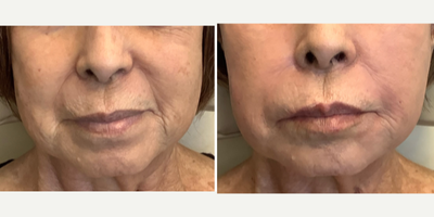 Sculptra before and after photo