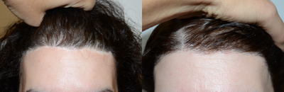 Transgender Facial Feminization Surgery before and after photo