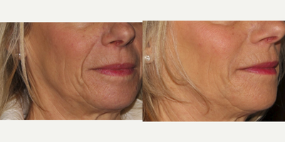 Juvederm before and after photo