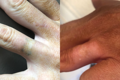 Tattoo Removal before and after photo