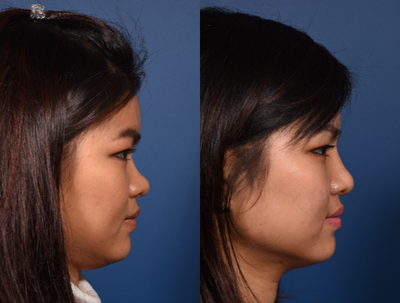 Asian Rhinoplasty before and after photo