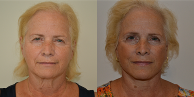 Facelift before and after photo