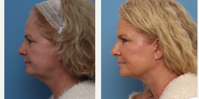 Facelift before and after photo