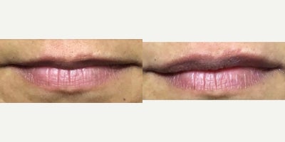 Lip Fillers before and after photo