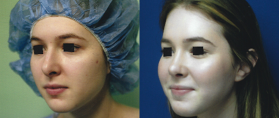 Rhinoplasty before and after photo