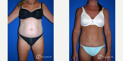 Tummy Tuck before and after photo