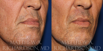 Beard Transplant before and after photo
