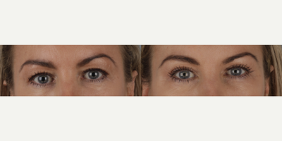 Eyelid Surgery before and after photo
