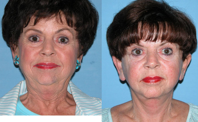 Facelift before and after photo