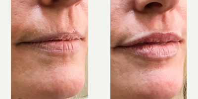 Lip Fillers before and after photo