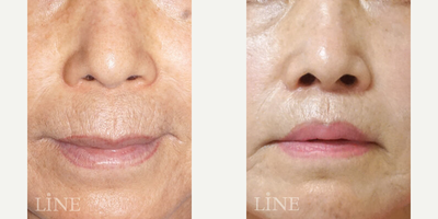 Lip Lift before and after photo