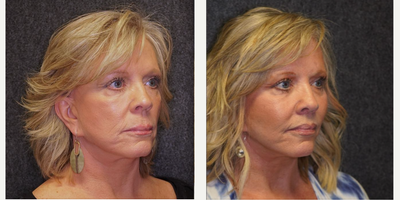 Lip Lift before and after photo