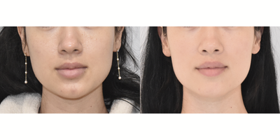 Lip Lift before and after photo