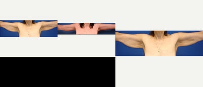 Liposuction before and after photo