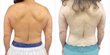 Smart Lipo before and after photo