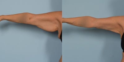 Arm Lift before and after photo