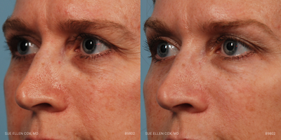 Botox before and after photo