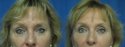 Eyelid Surgery before and after photo