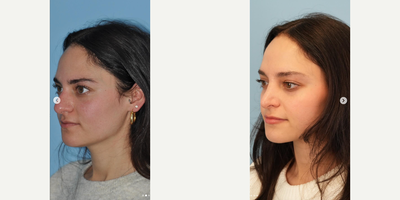 Rhinoplasty before and after photo