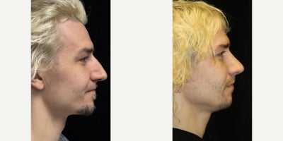 Rhinoplasty before and after photo