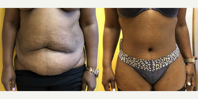 Tummy Tuck before and after photo
