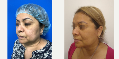 Chin Liposuction before and after photo
