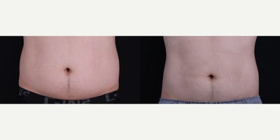 CoolSculpting before and after photo