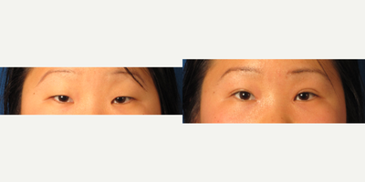 Double Eyelid Surgery before and after photo
