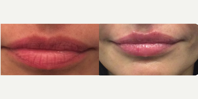 Juvederm before and after photo