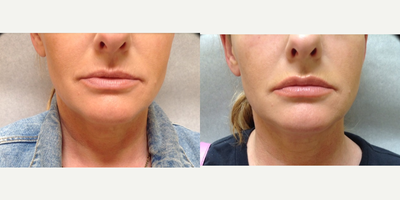 Lip Fillers before and after photo