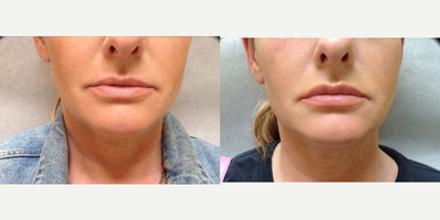 Lip Fillers before and after photo
