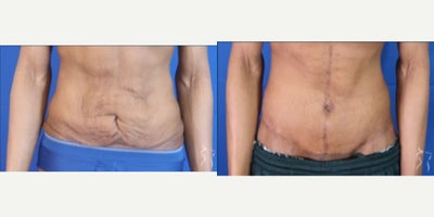 Tummy Tuck before and after photo